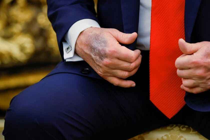 Что за чёрный синяк у Трампа на руке? В Белом доме дали объяснение