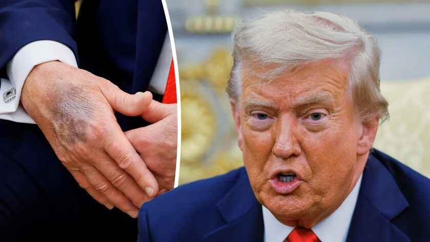 Что за чёрный синяк у Трампа на руке? В Белом доме дали объяснение