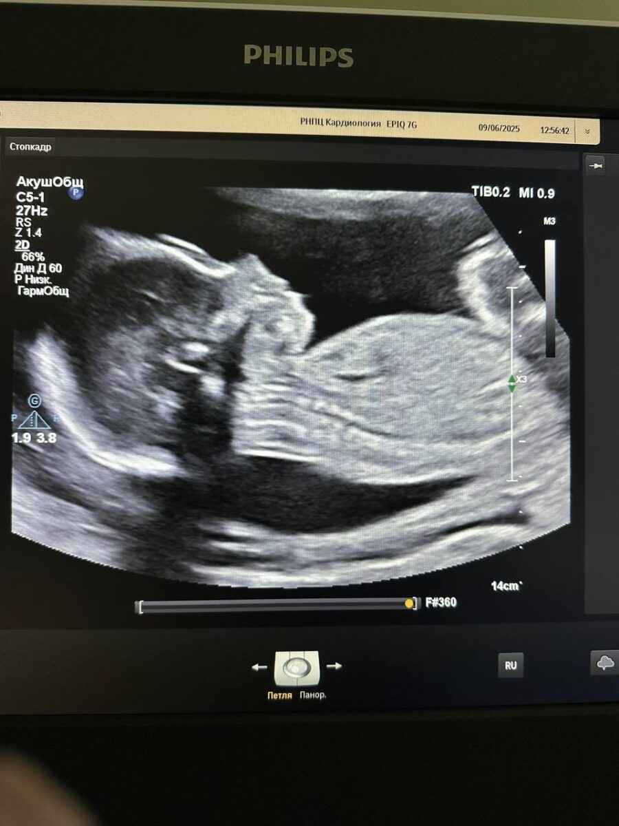 Белорусские кардиохирурги впервые успешно удалили опухоль ещё не родившемуся малышу