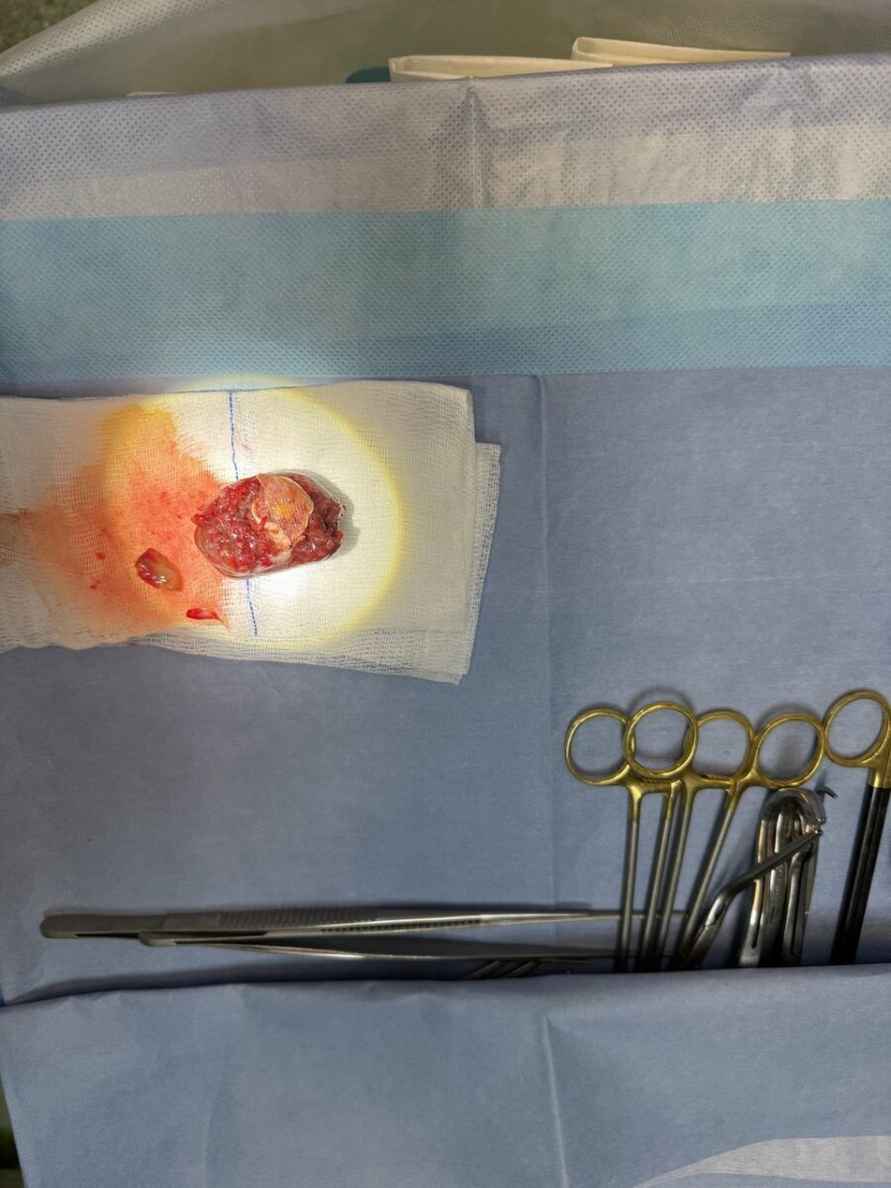 Белорусские кардиохирурги впервые успешно удалили опухоль ещё не родившемуся малышу