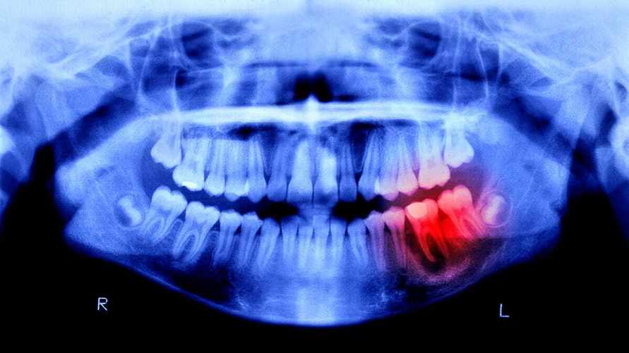 Когда же стоматологи начнут выращивать зубы вместо имплантов? Учёные уже тестируют 3 метода