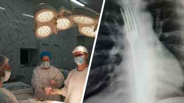 Медики извлекли из желудка жительницы Витебска вилку: «Два неловких движения»