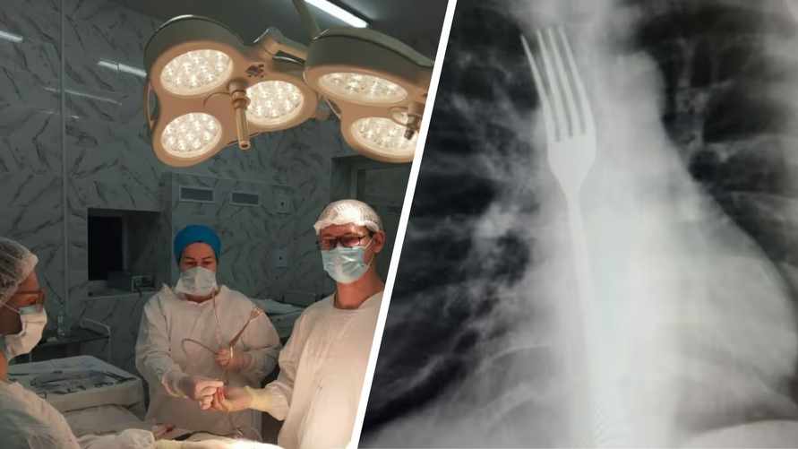 Медики извлекли из желудка жительницы Витебска вилку: «Два неловких движения»